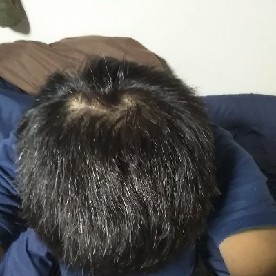 私のブログ
プロペシア15年以上服用 長期経過ブログhttps://t.co/UMhS4LT5Ne
プロペシアからザガーロに変更https://t.co/X6qwhhkGxQ
フィナステド歴(プロペシア)15年目
デュタステリド(ザガーロ)1年2ヵ月服用
自毛植毛手術 1回