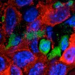 Brain Metastasis Research Group (@lorgerlab) 's Twitter Profile