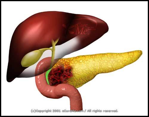 Everything about information, symptoms, treatments, causes, types of pancreatic cancer