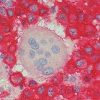 We study Langerhans Cell Histiocytosis, a rare pediatric blood cancer. We combine state of the art techniques and translational research to fight this disease.