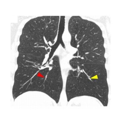 Our research aims to uncover disease mechanisms, develop disease biomarkers, and evaluate novel treatments for airway diseases.