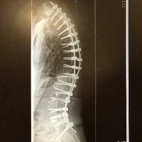 Oswestry Spine (@oswestryspine) 's Twitter Profile