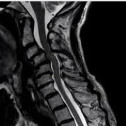 Post your T2 mid-sagittal cervical MRI and Surgical prediction will be returned.
opinion@eSpine.ai