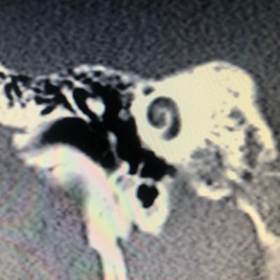 Terapia degli acufeni e dei disturbi dell'udito +39 06 58166 95