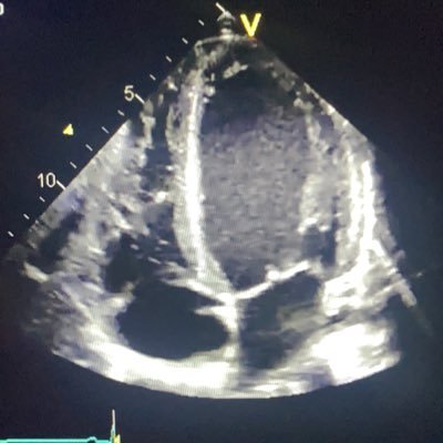 Point of Care Ultrasound Academy for medical students at KI since 2014. POCUS Akademi Tuesdays monthly at Kliniskt träningscentrum 4-6 pm.
