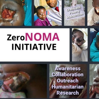 • Preventive and Encompassing Approach to #Noma
• Intersection of #OralHealth, #NTDs, #OneHealth #SDGs
• #ACOHR||#ProjectDOTS||#DecolonizeGlobalHealth