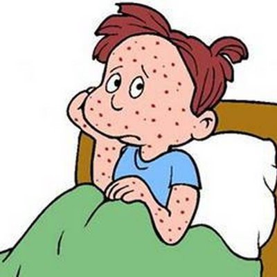 A team of NHS and University based researchers looking into UK parents’ views surrounding chickenpox & vaccination