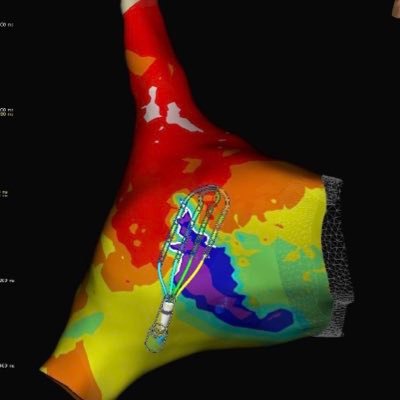 @AbbottCardio #EPeeps in the Bay Area. Highlighting interesting cases and signals! ❤️🩺