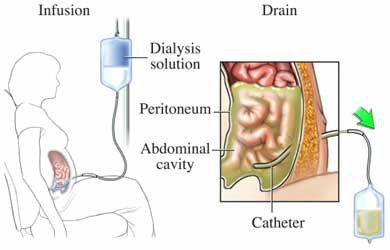 Peritoneal Dialysis Life Support Center. PD advocate.PD healthcare team.PD first policy.