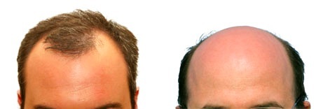 recedinghairlos's profile picture. Treatment solutions for men and women with hair loss problems.