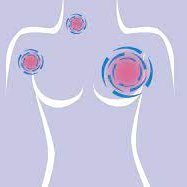 Breast cancer is cancer that develops from breast tissue. Signs of breast cancer may include a lump in the breast
T-shirts: https://t.co/oTDc0L9L9F