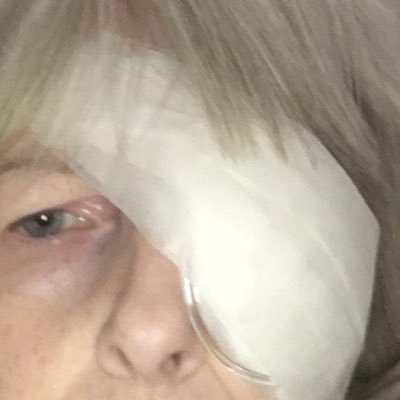 BekkaJo77's profile picture. I was fun, independent, go where I wanted, that was until I had Lens replacement. Big mistake, I now suffer with chronic pain, depression, eyesight worse now 😢