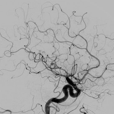 Unitat de Malalties Vasculars Cerebrals
Servei de Neurologia
Hospital de la Santa Creu i Sant Pau, Barcelona