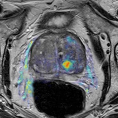 Imagine prostate cancer care without imaging!! Imaging matters for better quality care.