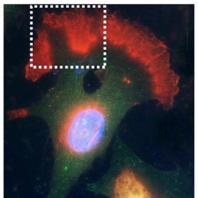 Interested in brain tumor stem cell biology and brain tumor immunology @emory @emoryskullbase