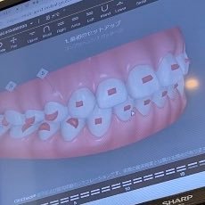 インビザライン 2021.5.19〜1st 25枚🤍 2022.7.5〜2nd 20枚🤍 2023.5.26〜 3rd 12枚🤍 2024.3.23〜4th 30枚🤍開咬 抜歯なし 2週間交換