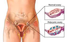 Ex-PCOS and Endometriosis sufferer. PCOS blogger. My goal is to help women deal with PCOS and endometriosis.