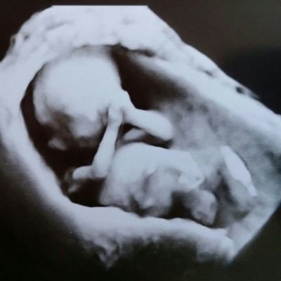 prenatal care, ultrasound, perinatology, twins ✦
novinky z fetální medicíny