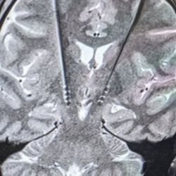Deep tweets from deep inside a human brain.