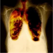 Get Mesothelioma Article here...