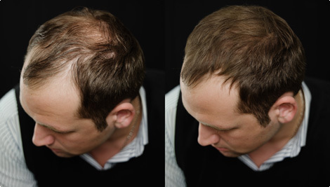 If you need a Hair Loss remedy, then we have what you need. For decades Hair Loss has been a struggle but we can show you how you can STOP looking bald ASAP!!!