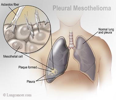 get your mesothelioma (cancer) information here