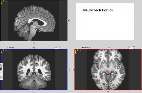 #Updates #neurotechnology #neurotech #interviews #social media #analytics with research, industry and financial leaders.