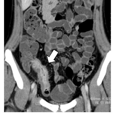 Official account of the Society of Abdominal Radiology Disease Focused Panel on Inflammatory Bowel Disease