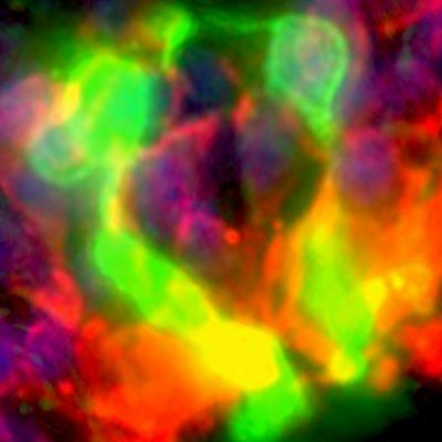Developing gene and autologous stem cell therapies to treat inherited blindness