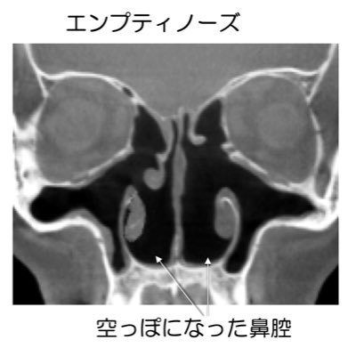 粘膜下下鼻甲介骨切除による後遺症です。手術をして良くなるはずがなぜ病気が増えるのか。西洋医学は対症療法と同じ、その場は良くても後から何かの病気が生じたり他の病気になります。人間は産まれた時から「粘膜、臓器、骨、他」など全て人体に必要だから生まれそれを取り除けば異変がおこる。