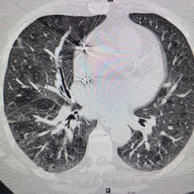 Cardiothoracic Radiologist | Director🫀 CT/MRI, Assistant PD @EmoryRadiology. Former
@MIRimaging, and @BrownUniversity, #IMG from @DowMedical 🇵🇰🇺🇲