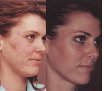 Soins Naturel de la Peau/Natural Skin Care - Acné, peau grasse, cicatrices, fermeté, cellulite. Conseils, Boutique en ligne Sélection Cosmétiques BIO inédits.