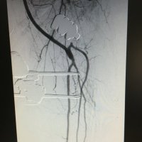 Servicio de Cirugía Vascular HUVN (@aycvascularhuvn) 's Twitter Profile Photo