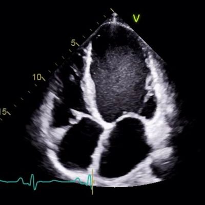 Echocardiogram tips