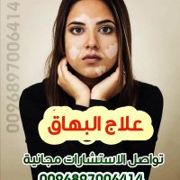 البهاق. حالة شفيت من مرض البهاق سلطنة عمان٧ (@lxxqtejeehtu2kp) 's Twitter Profile
