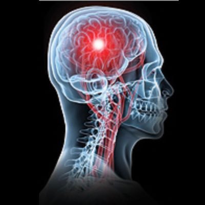 NBTstroke Profile