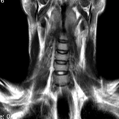 Spinal Cord NFT