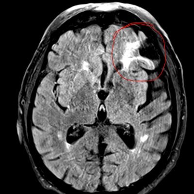 Clinician Scientist @StrokeBern @inselgruppe
Covert brain infarction | Anticoagulation | Precision medicine | Heart-Brain
Family dad, 🇪🇺
