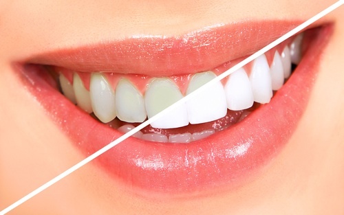 Welcome to http://t.co/WARtFBvLkQ we offer a teeth whitening products to help you maintain beautiful natural looking PearlyTeeth.