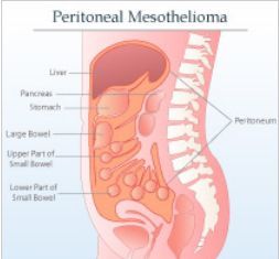 Mesothelioma is a form or a very rare disease of cancer. The disease is usually found in the mesothelial lining of the lungs, heart or abdomen.