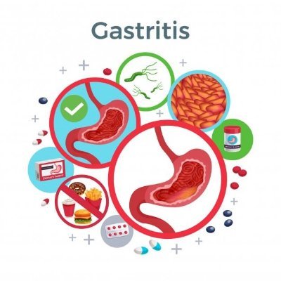 Esta pagina es acerca de la gastritis aguda para que comprendas que es y como prevenirla.
¡Cuida tu cuerpo!