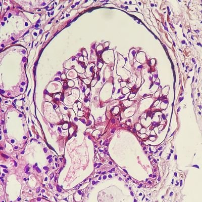 Consultant Nephropathologist, Manipal Hospital, Bangalore; Alumnus PGIMER-Chandigarh. Fan of #ECneph #renalpath #askrenalpath

Tweets / opinions are personal☺️