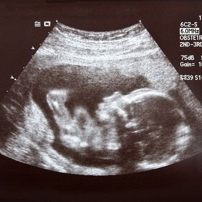 A collection of information on the taxpayer-funded fetal research projects at the University of Pittsburgh. This account is not associated with the university.