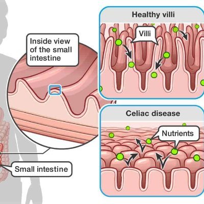 Navigating celiac disease for our preschooler, raising awareness, & advocating for celiac-safe, gluten free food practices & options in restaurants & schools.