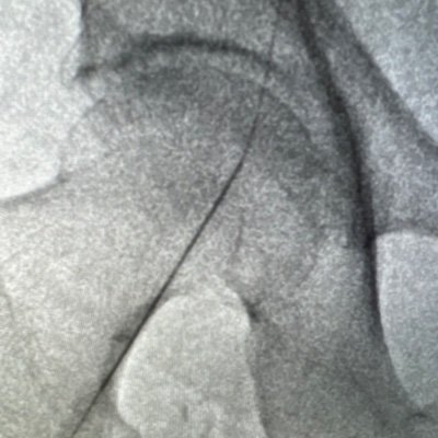 IR_Gawd's profile picture. I’m just a simple farm boy. With my hands and my tubes. Longtime learner, first time tweeter. #FluidFighters #IR #IRad #MinimallyInvasive