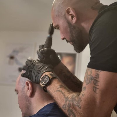 Scalp Micro Pigmentation Clinic. SMP Is A State Of The Art #Hairloss Concealer. Guaranteed Results For Men & Women. Quick, Effective & Non Surgical.