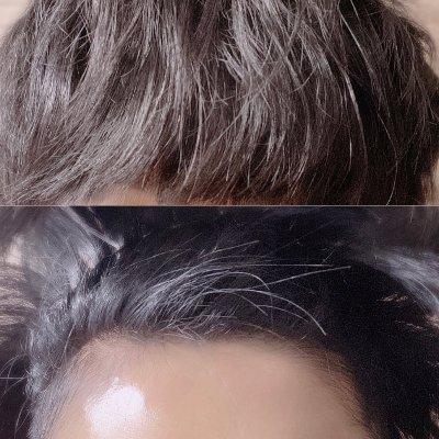 AGA治療アカ(美容も少し)。27歳の頃に薄毛気付き、割と早い段階で投薬を開始。両祖父ツルツルのサラブレッド。治療薬はデュタ0.5mg×2・ミノタブ1.25mg・塗りミノ夜7%朝5%,ケトコナゾールシャンプー,サプリはノコギリヤシ・亜鉛。その他ヘアマックス。育毛は人生。