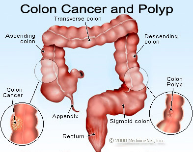 Read about colon and rectal cancer or also known as colorectal cancer here...