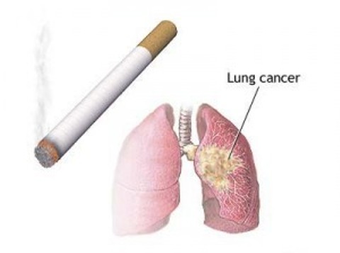 Read about LUNG, MESOTHELIOMA, and ASBESTOS cancer here...