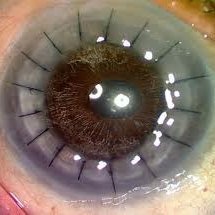 Keratoconus diagnosis 1968 and 1970. Cornea transplants 1980 and 1982. Retired, Ordained Southern Baptist Music Minister